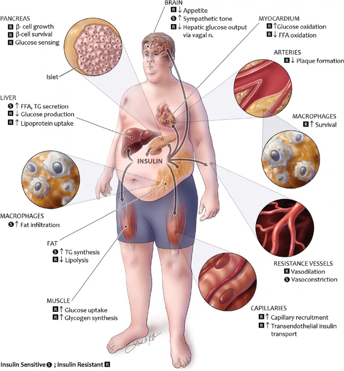 curcuma diabete sindrome metabolica