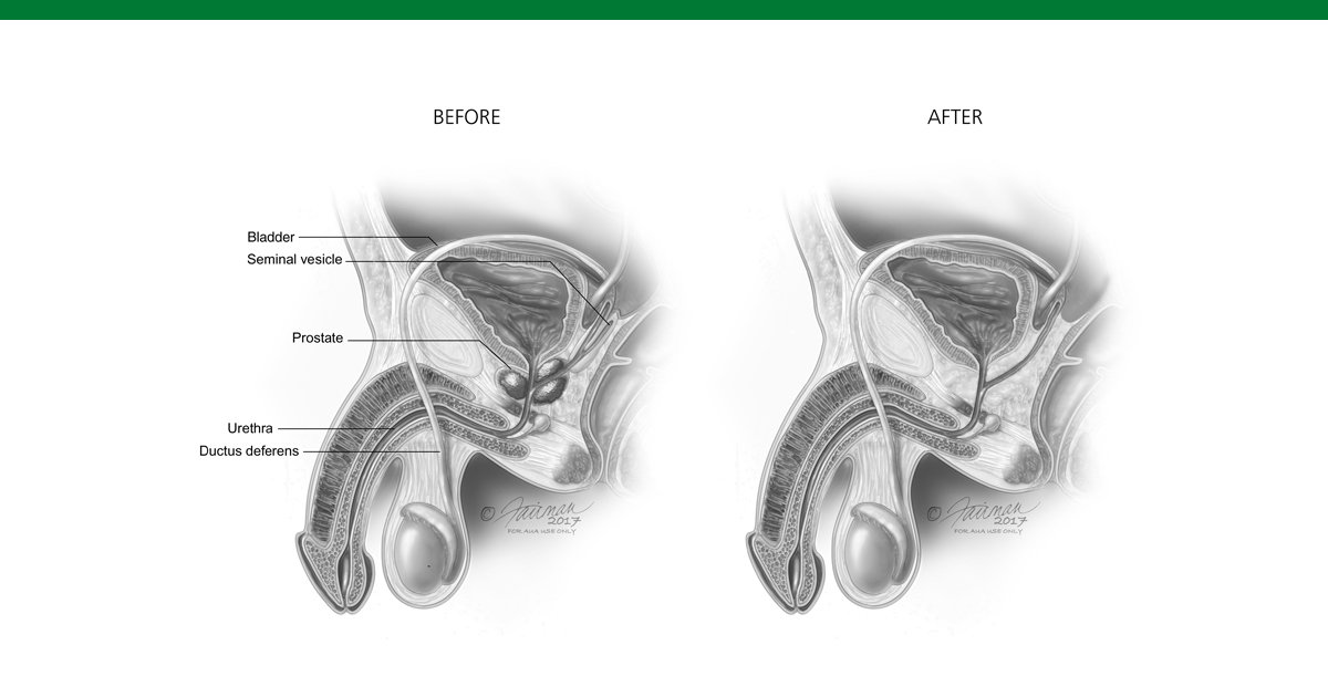 anatomia della prostata e prostata infiammata